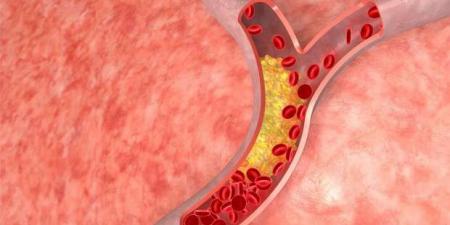 4 علامات في العين تشير إلى ارتفاع نسبة كوليسترول الدم.. اذهب إلى الطبيب - أرض المملكة