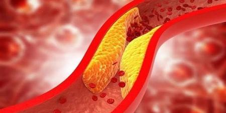 دراسة تكشف عن ارتباط بين الكوليسترول الجيد والإصابة بالجلوكوما - أرض المملكة