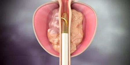 باحثون أمريكيون يطورون علاجا مبتكرا لسرطان البروستاتا دون جراحة - أرض المملكة