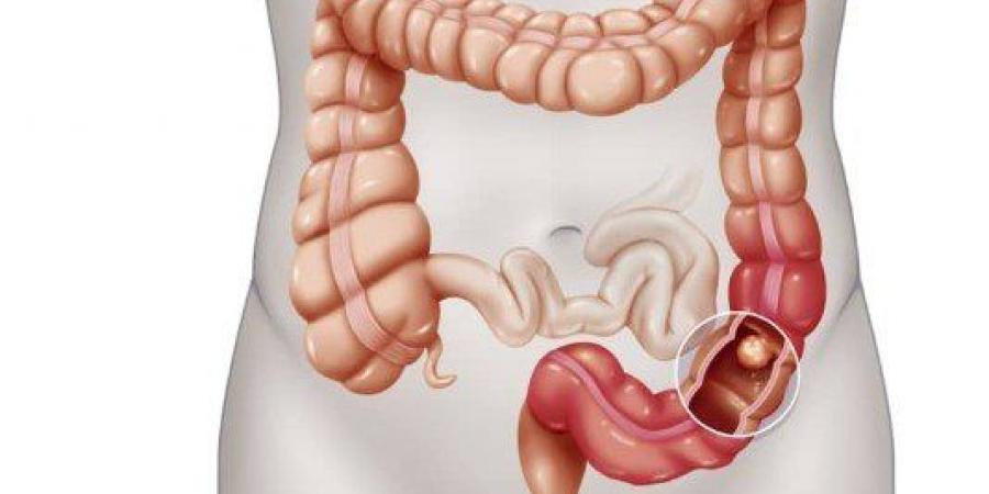 سرطان القولون.. الأعراض وطرق الوقاية - أرض المملكة