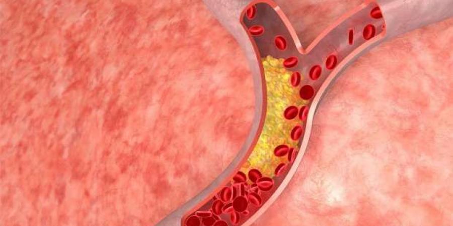 4 علامات في العين تشير إلى ارتفاع نسبة كوليسترول الدم.. اذهب إلى الطبيب - أرض المملكة