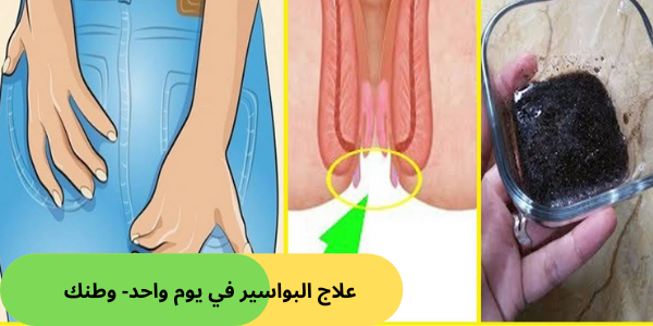 علاج البواسير في يوم واحد- وطنك